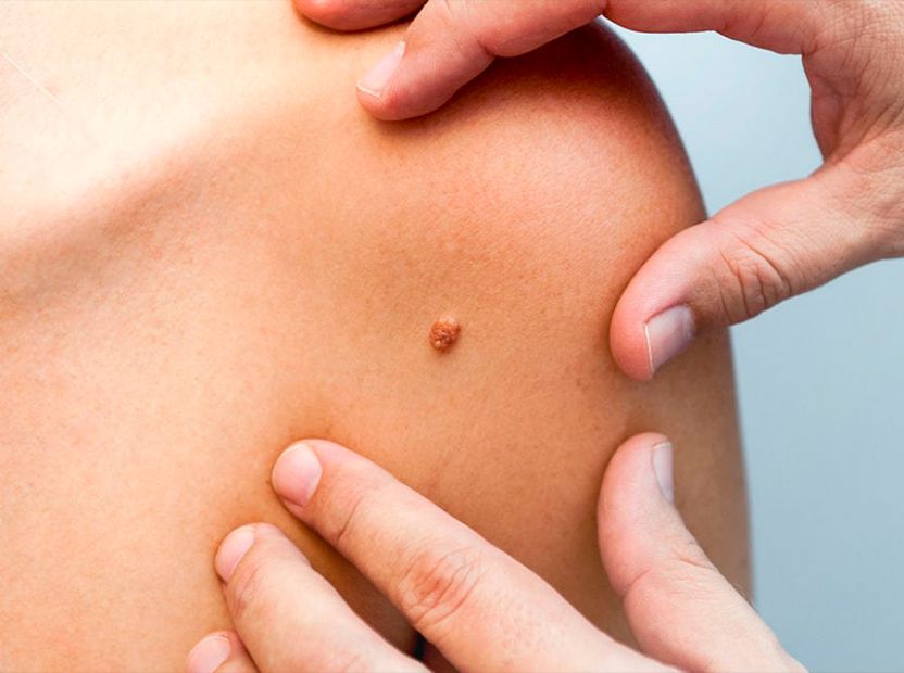 Адам папиллома вирусы (АПВ).