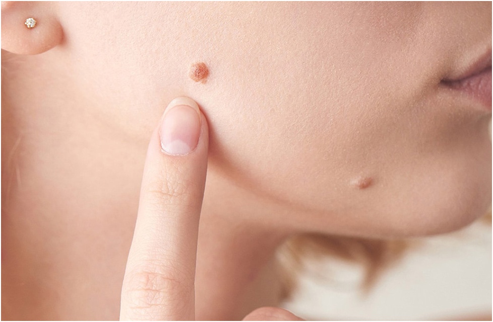 Адам папиллома вирусы (АПВ) және оның алдын-алу